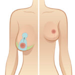 Reduction Mammoplasty