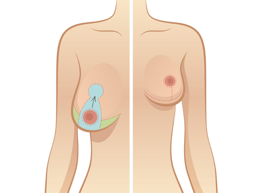 Reduction Mammoplasty