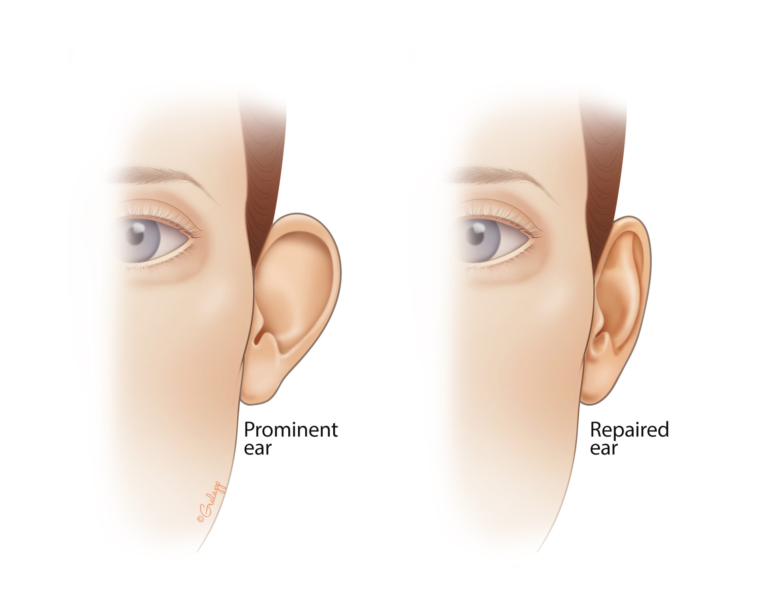 Otoplasty