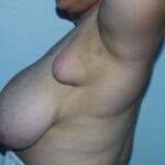Accessary Breast Surgery
