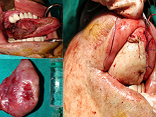 Tongue Reconstruction