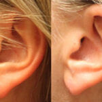 Ear Repair Surgery
