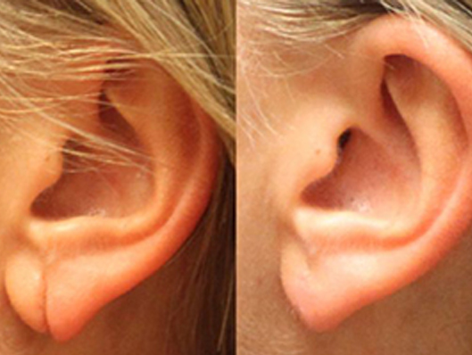 Ear Repair Surgery