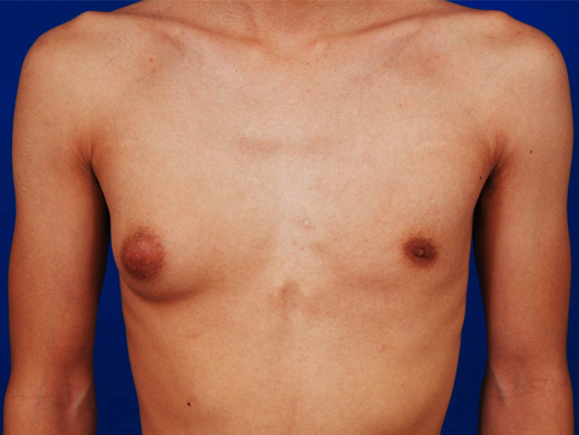 Gynecomastia